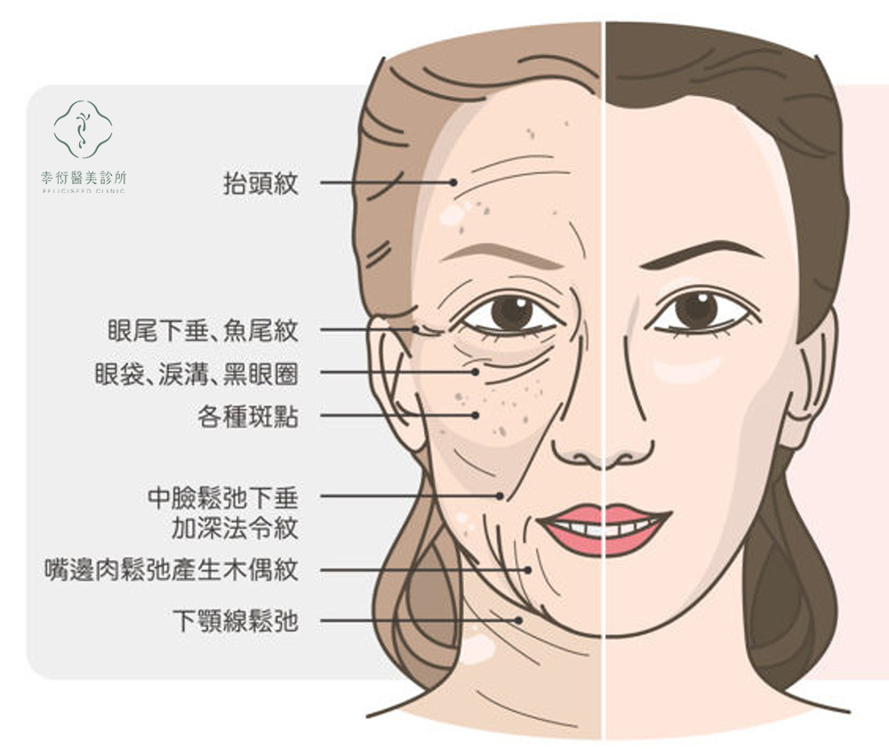 皮膚老化症狀