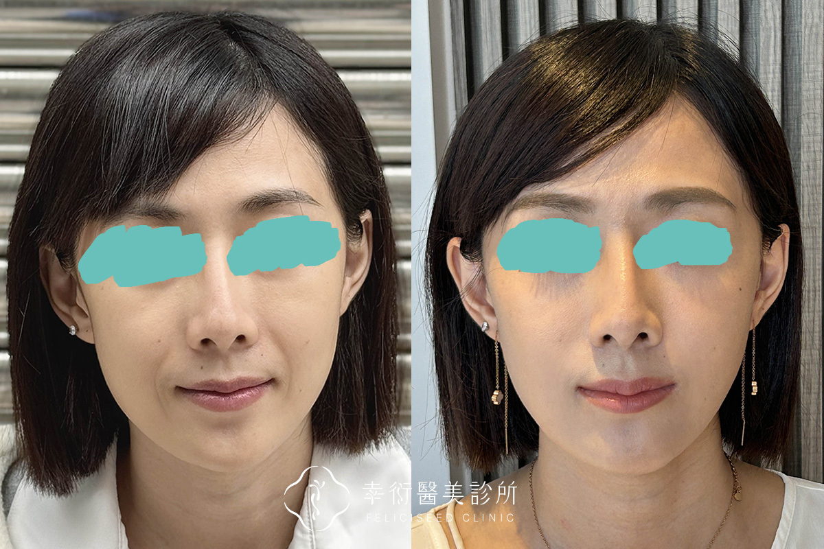 括號紋、木偶紋與嘴角輕微下垂